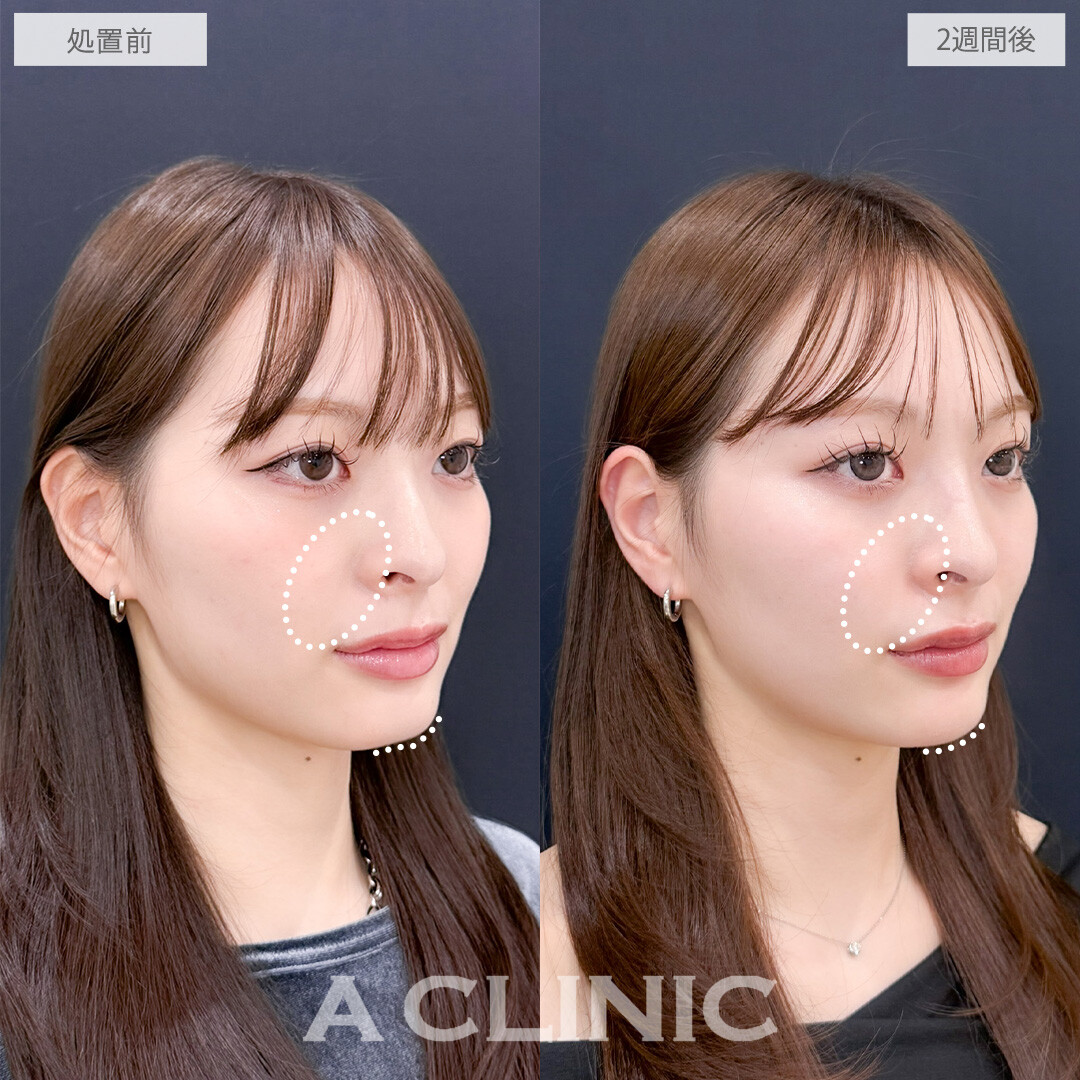 ヒアルロン酸カスタマイズメニューで全体的に立体感を出すことができます！こちら処置前と2週間後の症例です(20代女性)