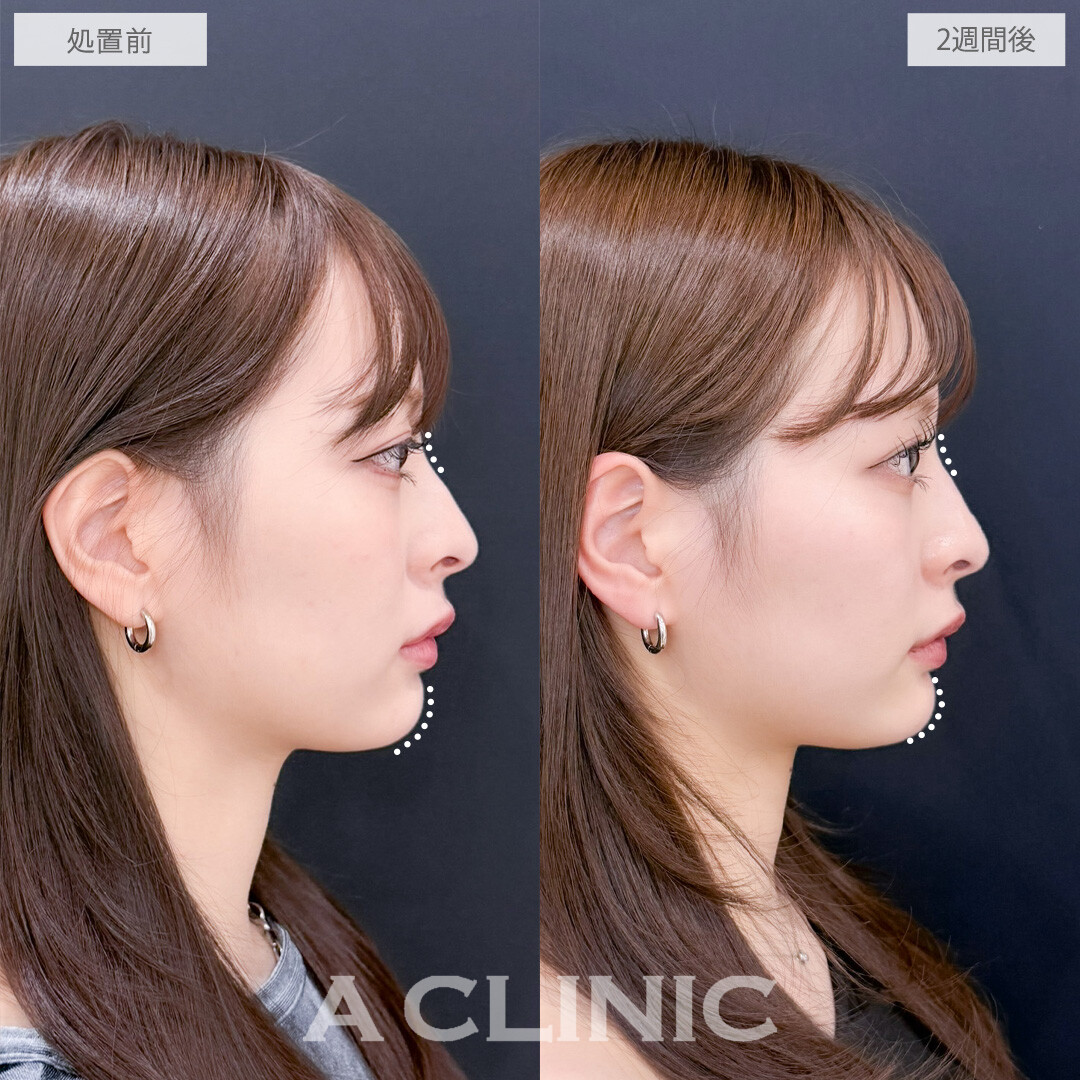 ヒアルロン酸カスタマイズメニューで全体的に立体感を出すことができます！こちら処置前と2週間後の症例です(20代女性)