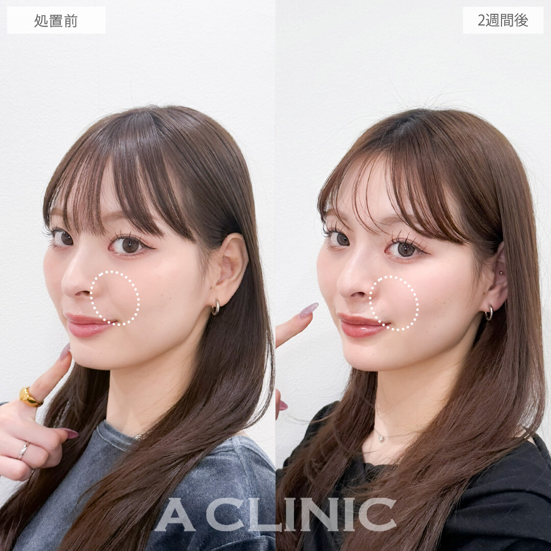ヒアルロン酸カスタマイズメニューで全体的に立体感を出すことができます！こちら処置前と2週間後の症例です(20代女性)