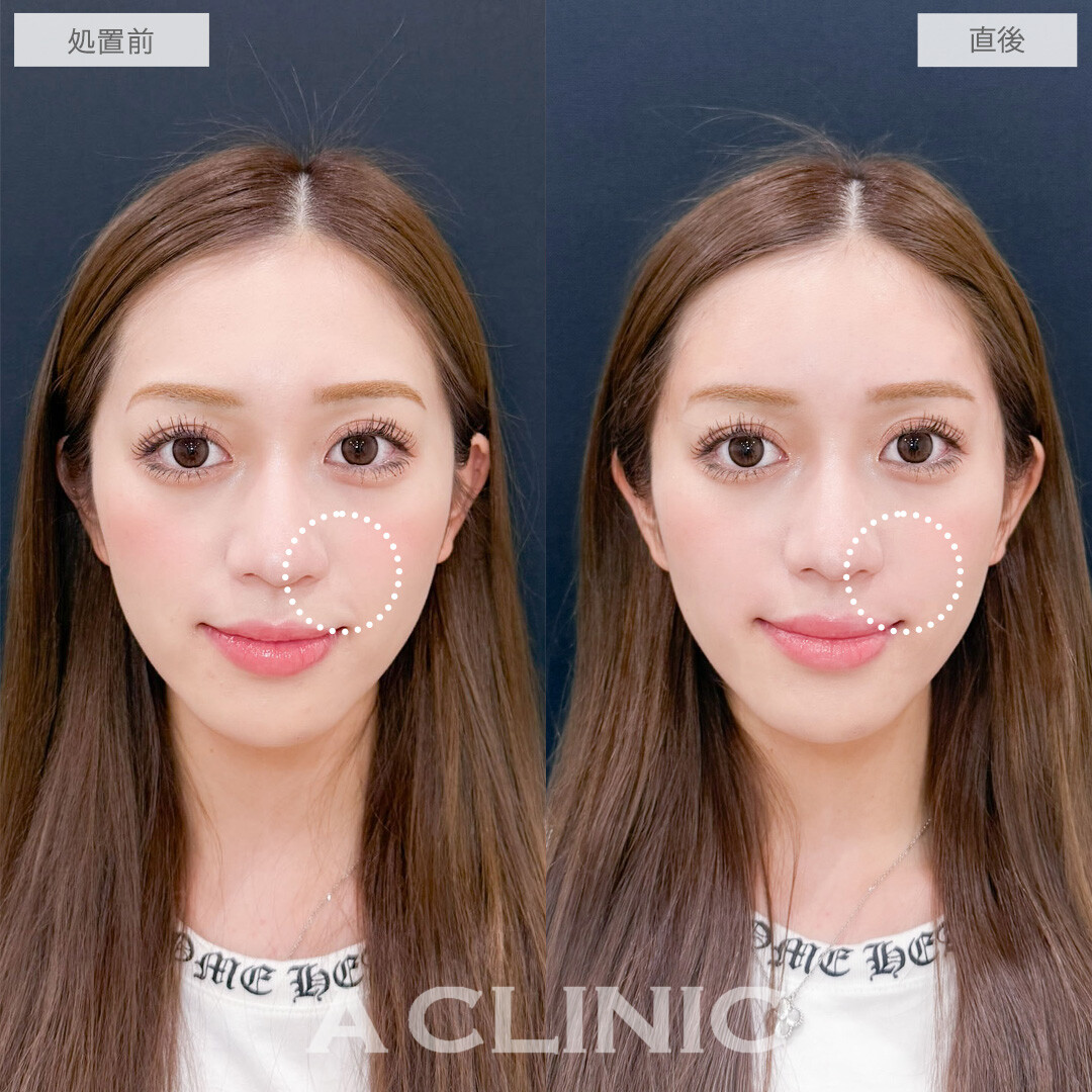 ヒアルロン酸カスタマイズメニューで気になる凹みをなくしてお顔全体の雰囲気を柔らかく！こちら処置前と直後の症例です(20代女性)