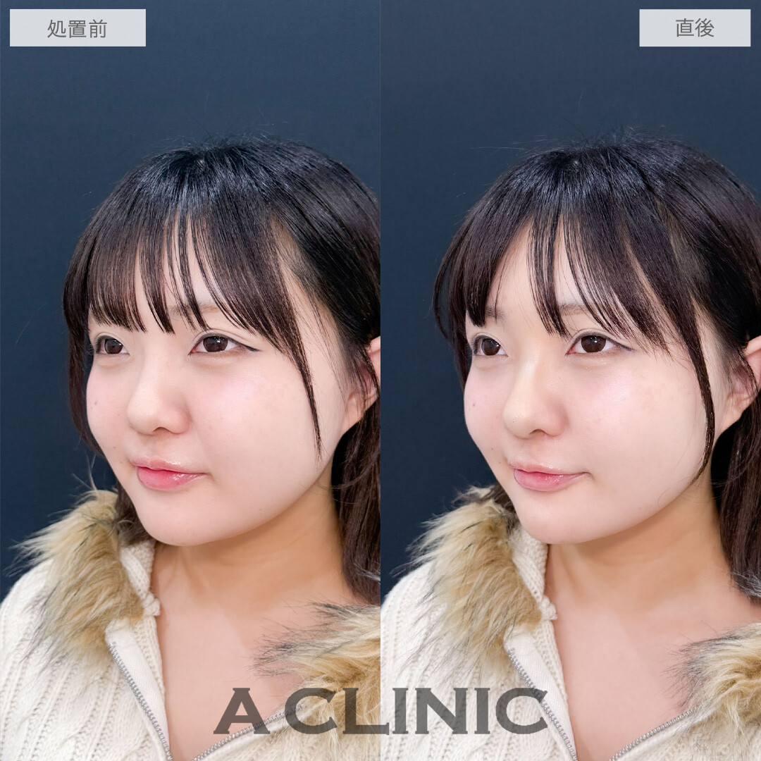 ヒアルロン酸カスタマイズメニューで鼻と顎を整えEラインがきれいになりました！こちら処置前と直後の症例です(20代女性)