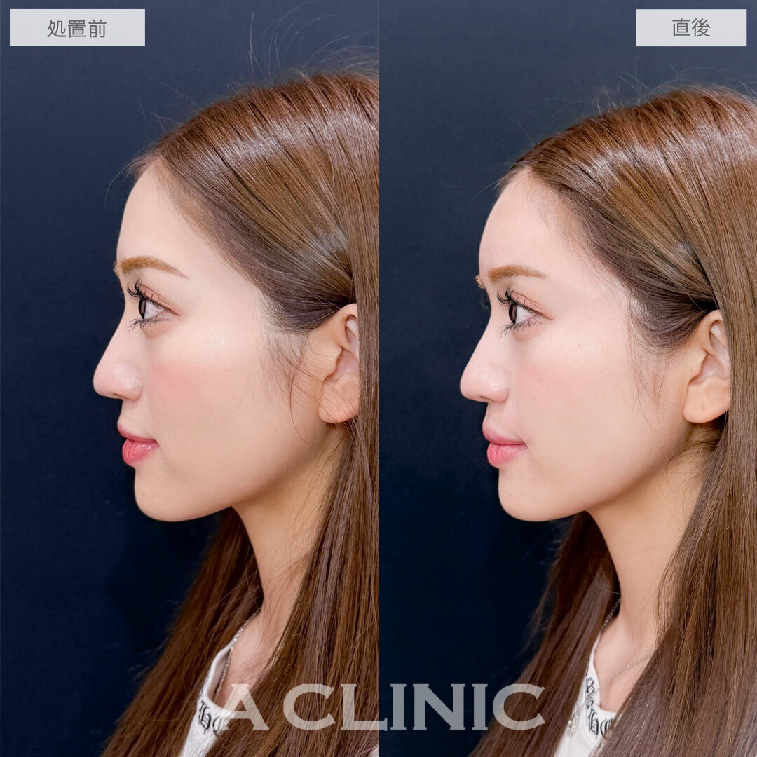 ヒアルロン酸カスタマイズメニューで気になる凹みをなくしてお顔全体の雰囲気を柔らかく！こちら処置前と直後の症例です(20代女性)