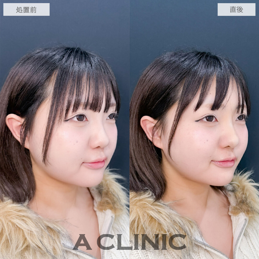 ヒアルロン酸カスタマイズメニューで鼻と顎を整えEラインがきれいになりました！こちら処置前と直後の症例です(20代女性)