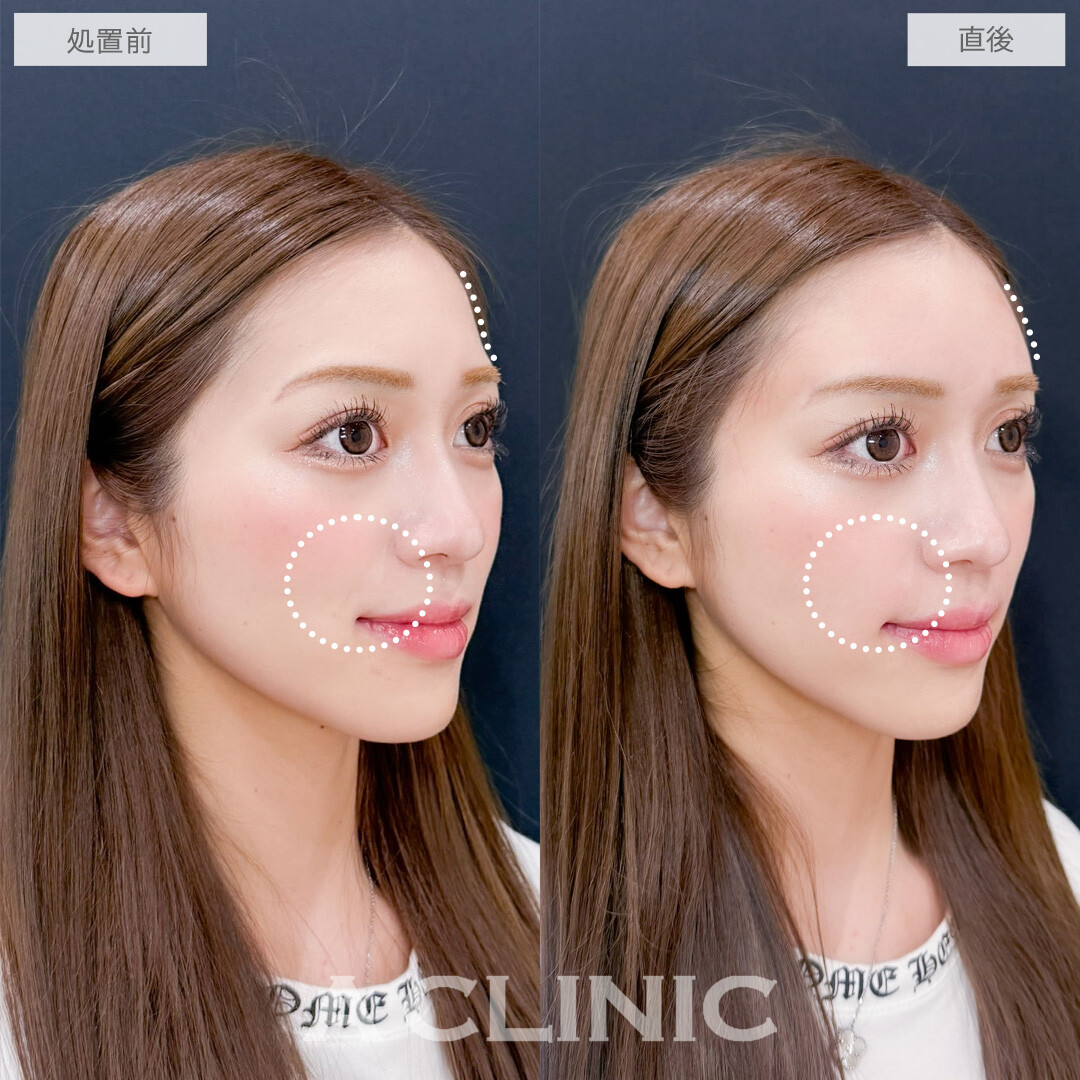 ヒアルロン酸カスタマイズメニューで気になる凹みをなくしてお顔全体の雰囲気を柔らかく！こちら処置前と直後の症例です(20代女性)