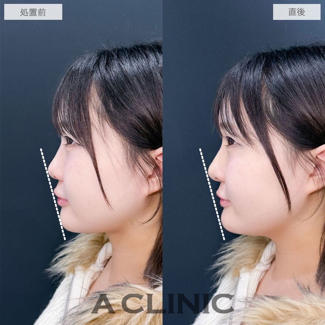 ヒアルロン酸カスタマイズメニューで鼻と顎を整えEラインがきれいになりました！こちら処置前と直後の症例です(20代女性)