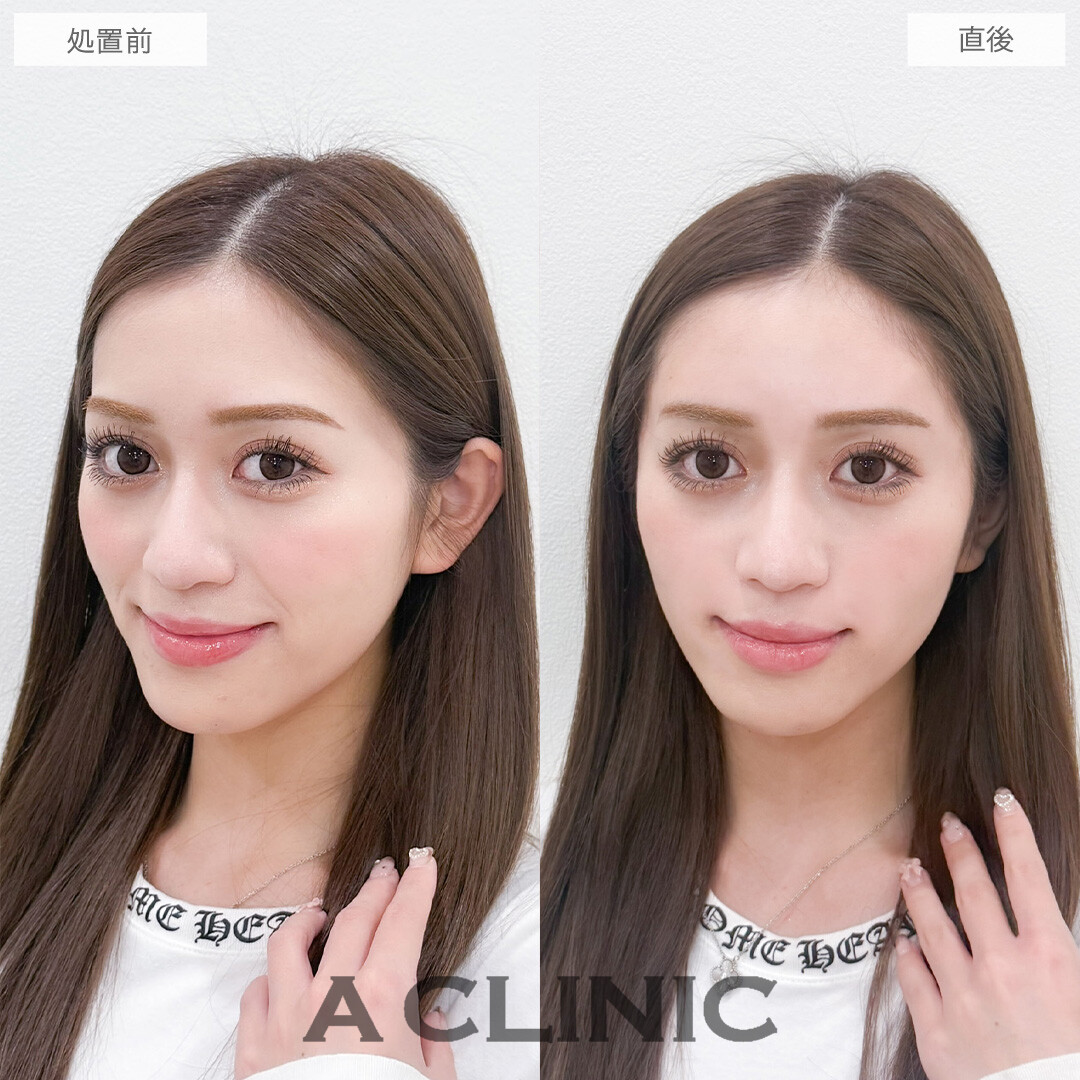 ヒアルロン酸カスタマイズメニューで気になる凹みをなくしてお顔全体の雰囲気を柔らかく！こちら処置前と直後の症例です(20代女性)