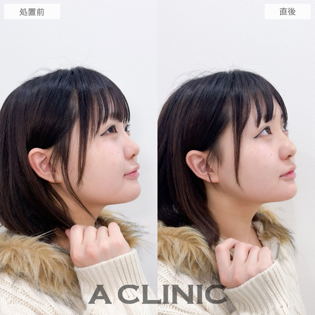 ヒアルロン酸カスタマイズメニューで鼻と顎を整えEラインがきれいになりました！こちら処置前と直後の症例です(20代女性)