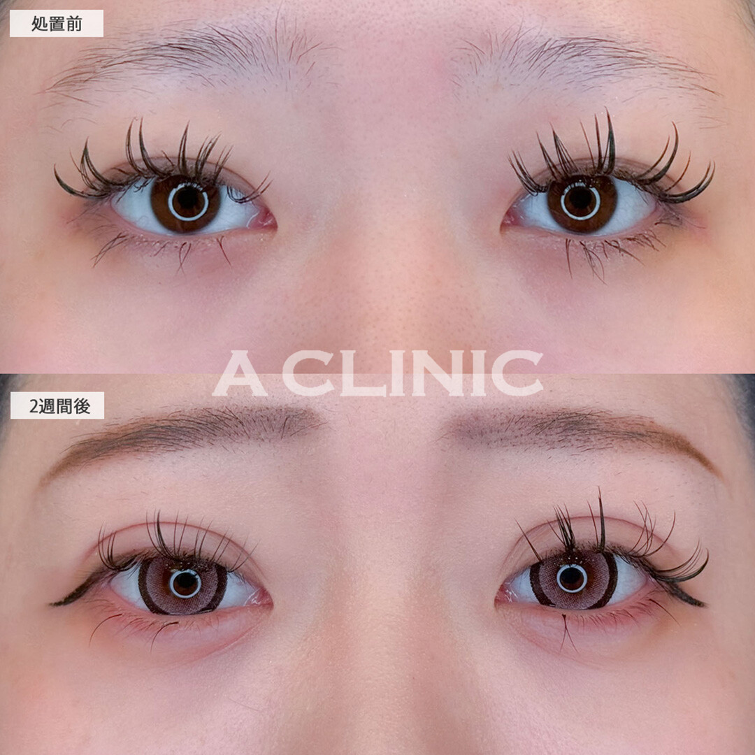 ドーリーアイズでしっかり幅を広げ目元を可愛くアップデート！こちら処置前と2週間後の症例です(20代女性)
