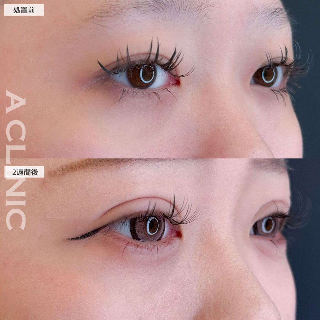 ドーリーアイズでしっかり幅を広げ目元を可愛くアップデート！こちら処置前と2週間後の症例です(20代女性)