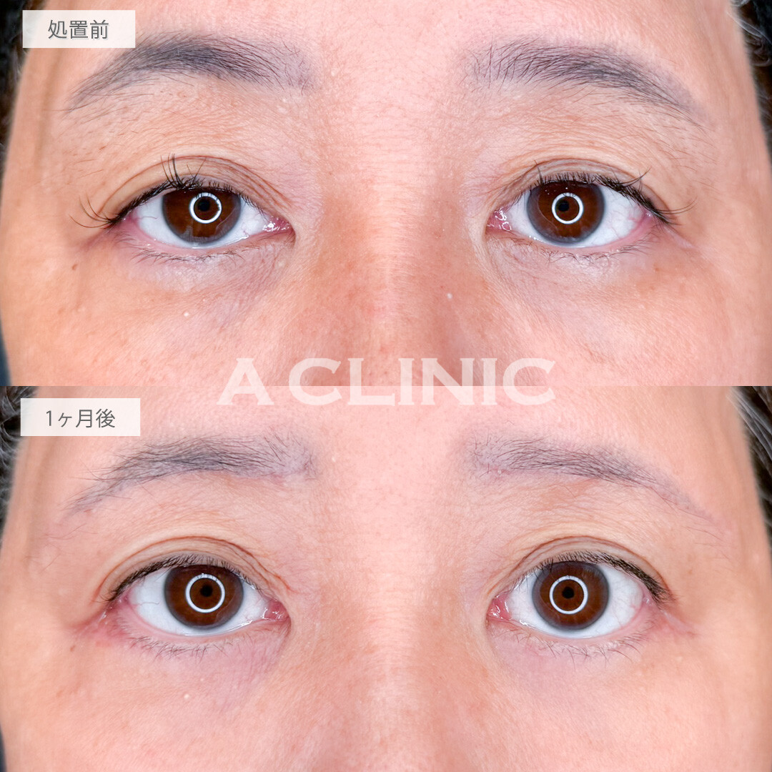 眉下リフトと目の下のたるみ取りでしわとたるみを改善し若々しい目元に！処置前と1ヶ月後の症例です(60代女性)