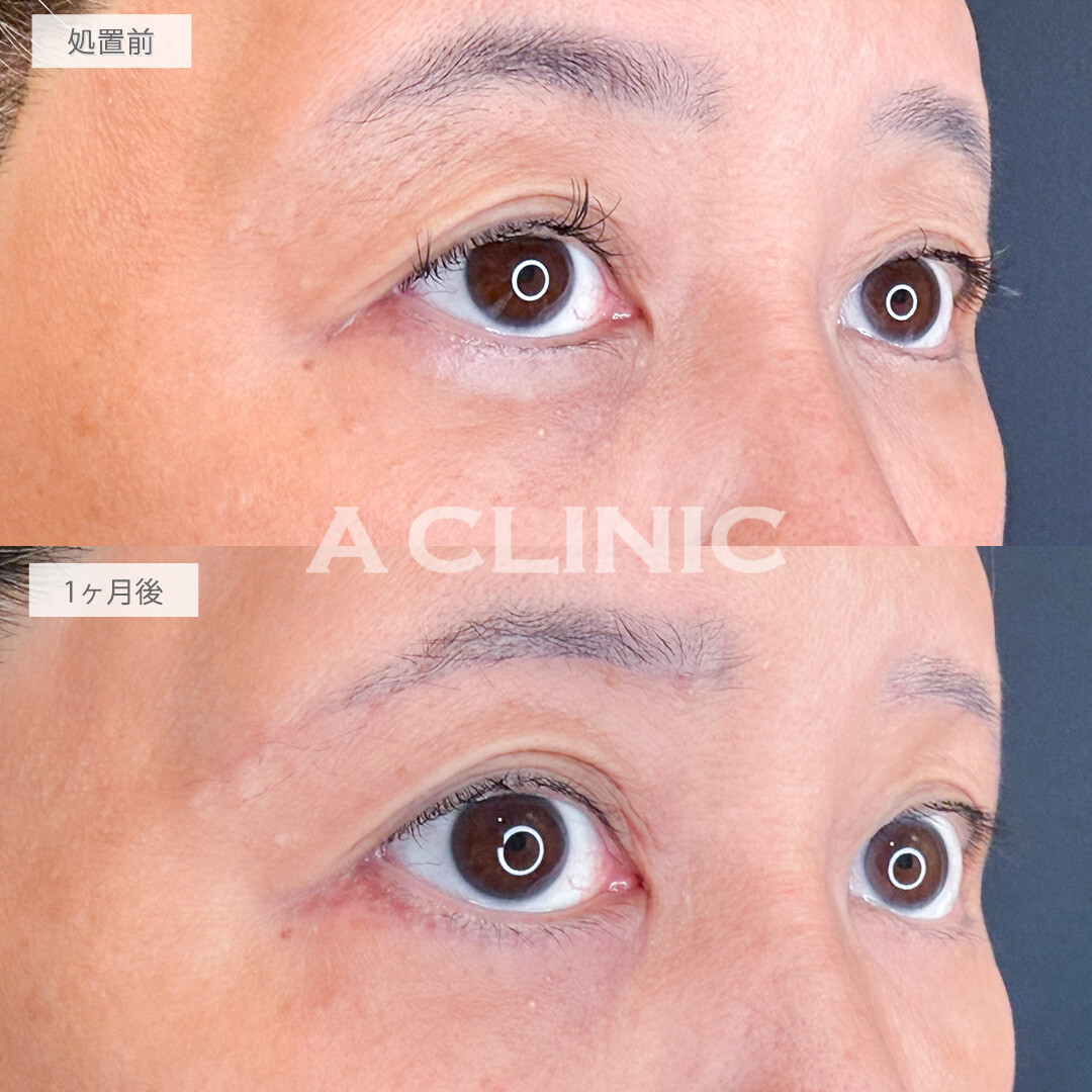 眉下リフトと目の下のたるみ取りでしわとたるみを改善し若々しい目元に！処置前と1ヶ月後の症例です(60代女性)