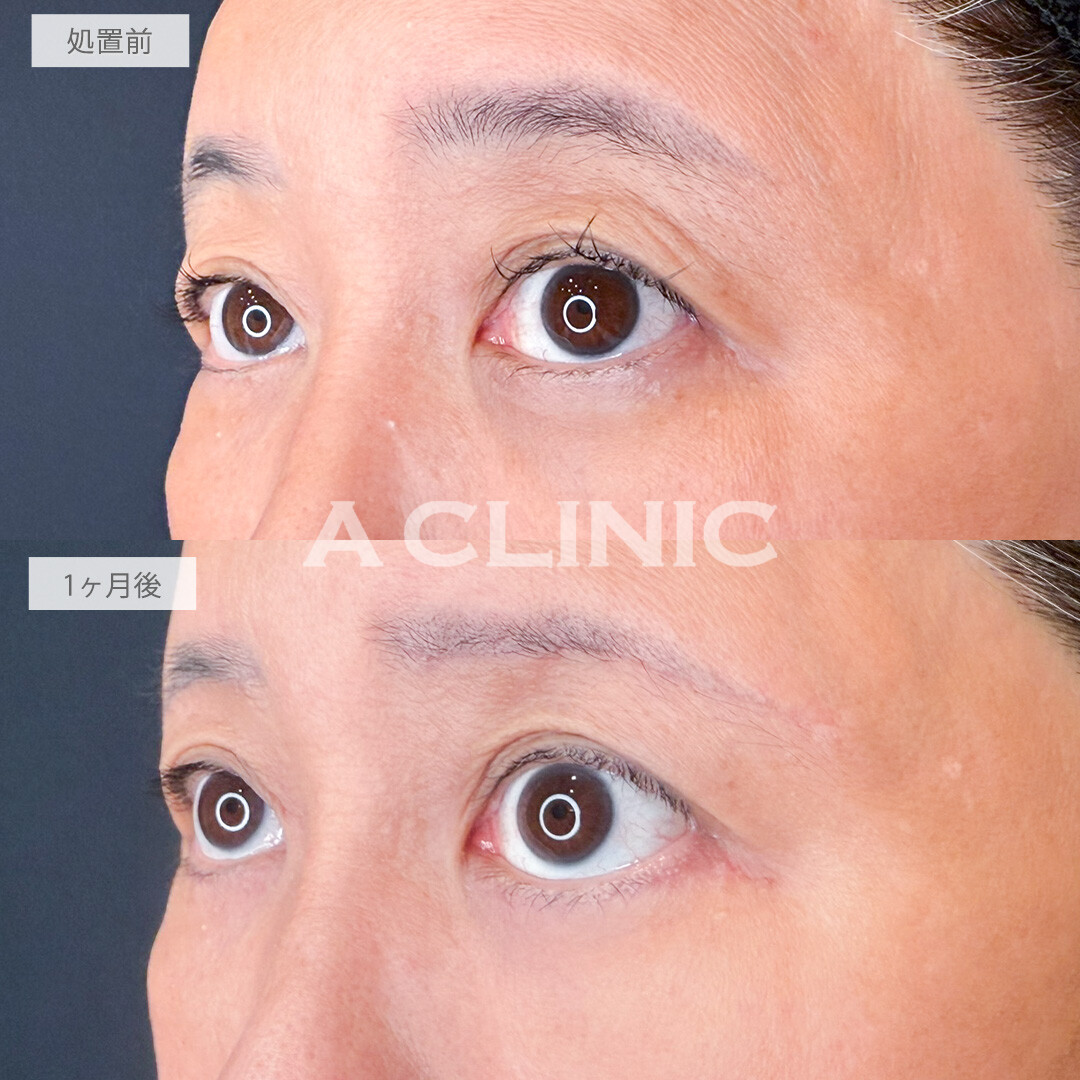 眉下リフトと目の下のたるみ取りでしわとたるみを改善し若々しい目元に！処置前と1ヶ月後の症例です(60代女性)