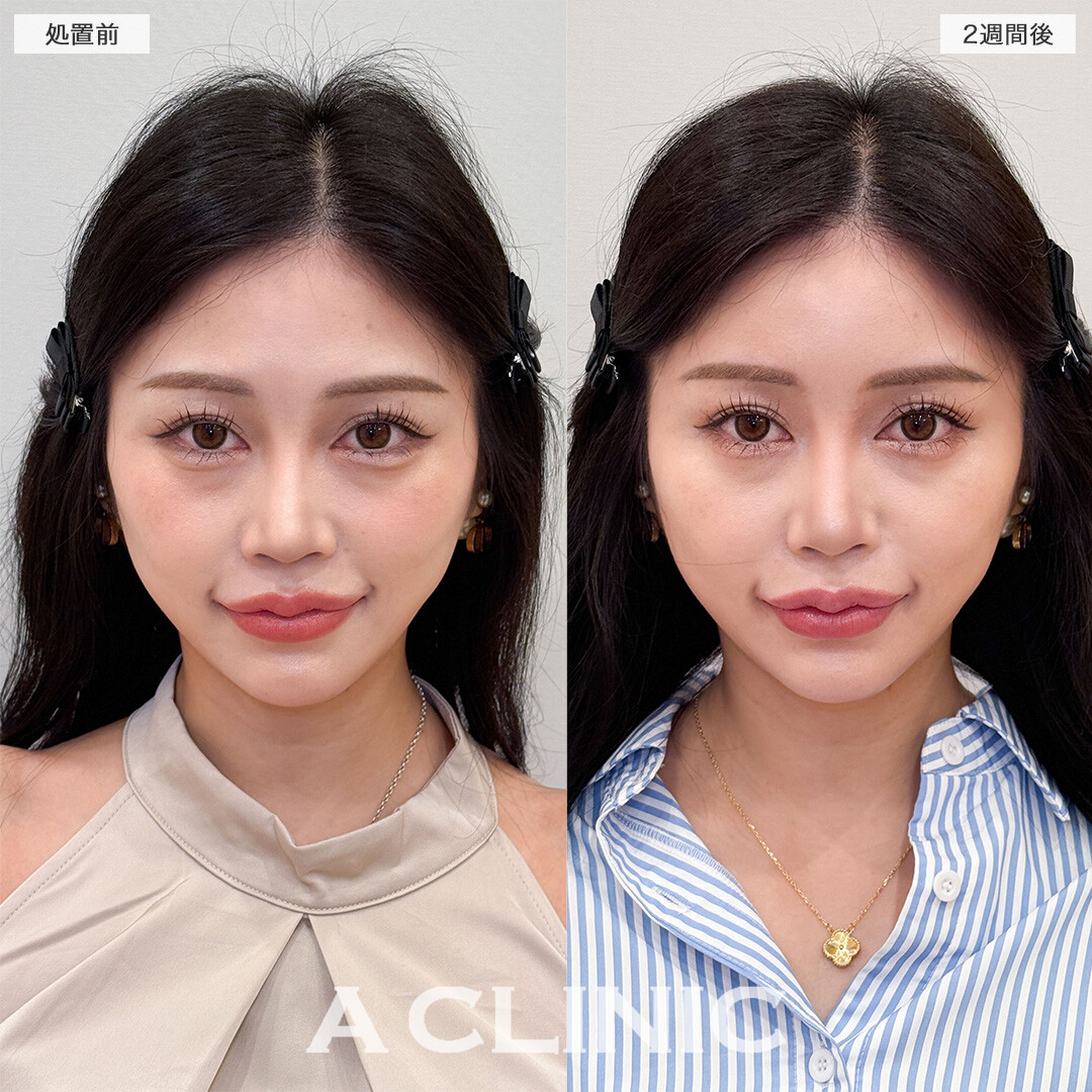ヒアルロン酸カスタマイズメニューで女性らしいフォルムに変化！処置前と2週間後の症例です(30代女性)