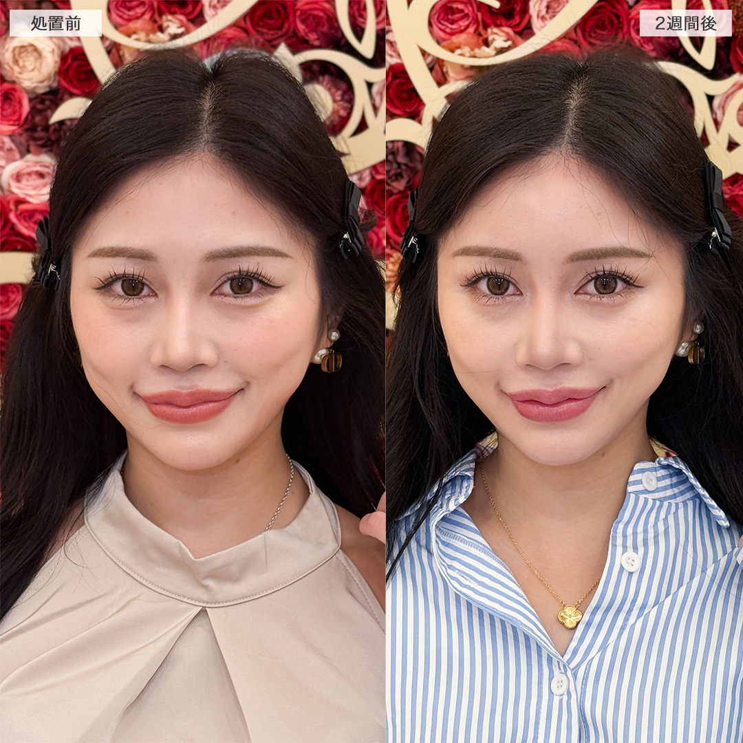 ヒアルロン酸カスタマイズメニューで女性らしいフォルムに変化！処置前と2週間後の症例です(30代女性)