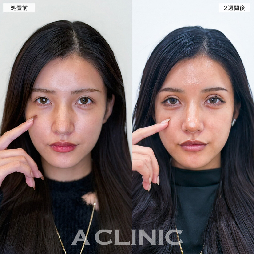 二重術埋没法で憧れの海外セレブ風の立体的な二重ラインへ！こちら処置前と2週間後の症例です(20代女性)