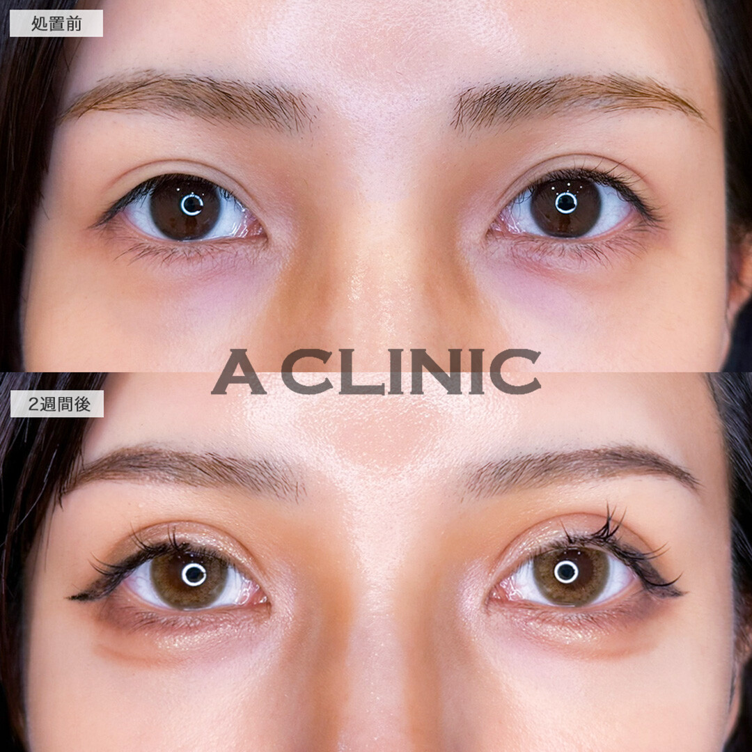 二重術埋没法で憧れの海外セレブ風の立体的な二重ラインへ！こちら処置前と2週間後の症例です(20代女性)