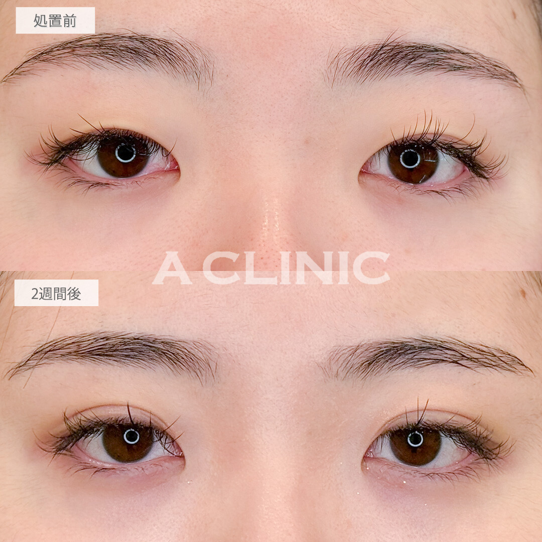 二重術埋没法でアイテープ卒業しメイク時間短縮できました！処置前と2週間後の症例です(10代女性)