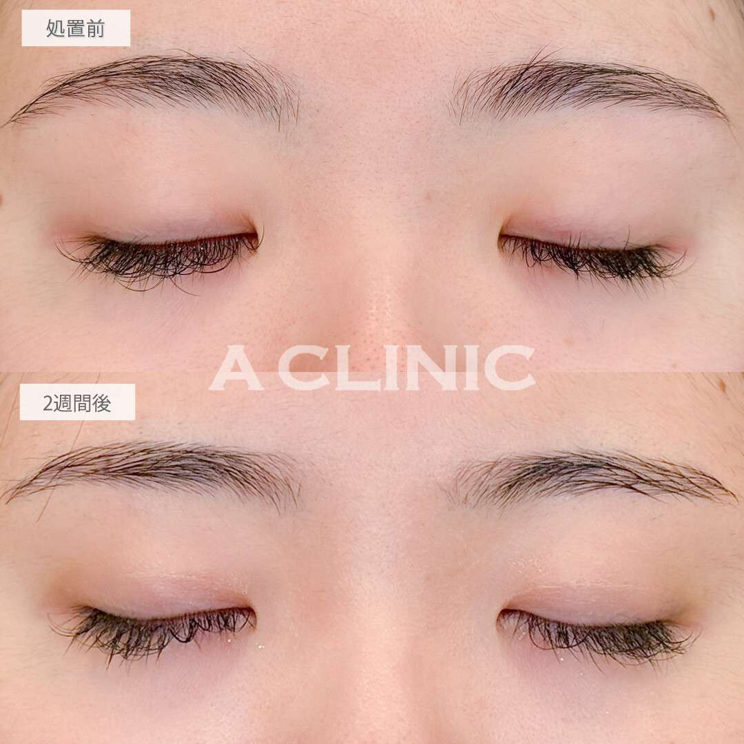 二重術埋没法でアイテープ卒業しメイク時間短縮できました！処置前と2週間後の症例です(10代女性)
