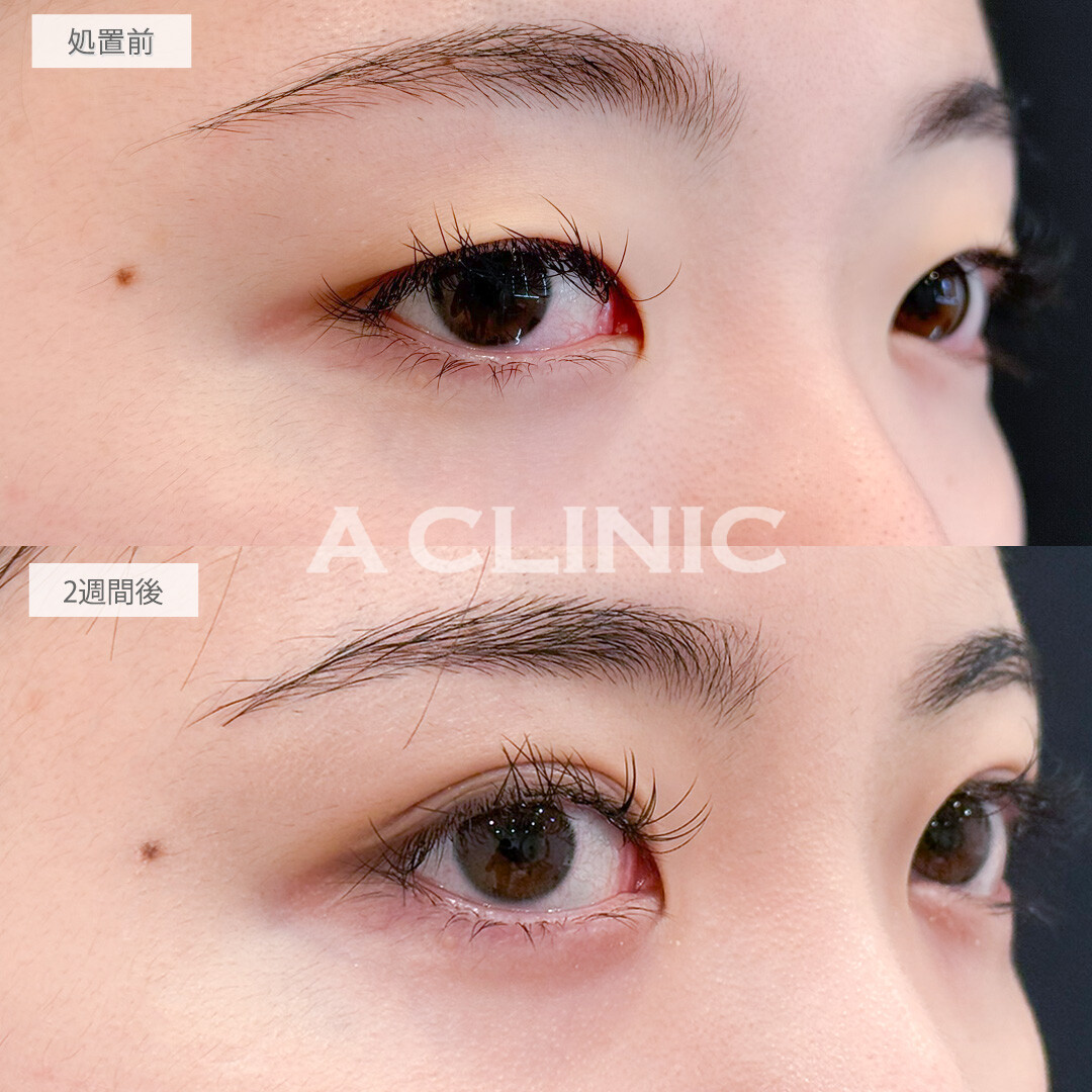 二重術埋没法でアイテープ卒業しメイク時間短縮できました！処置前と2週間後の症例です(10代女性)