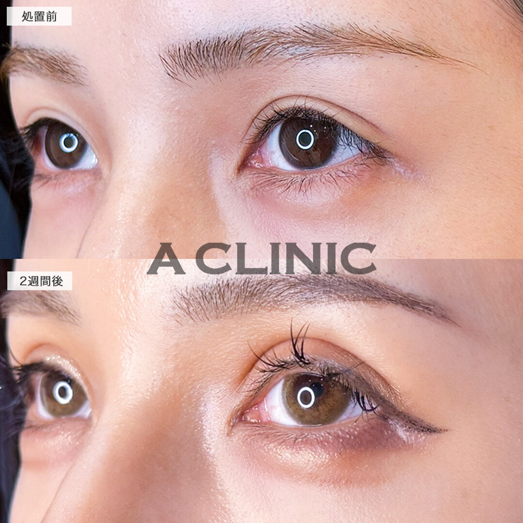 二重術埋没法で憧れの海外セレブ風の立体的な二重ラインへ！こちら処置前と2週間後の症例です(20代女性)