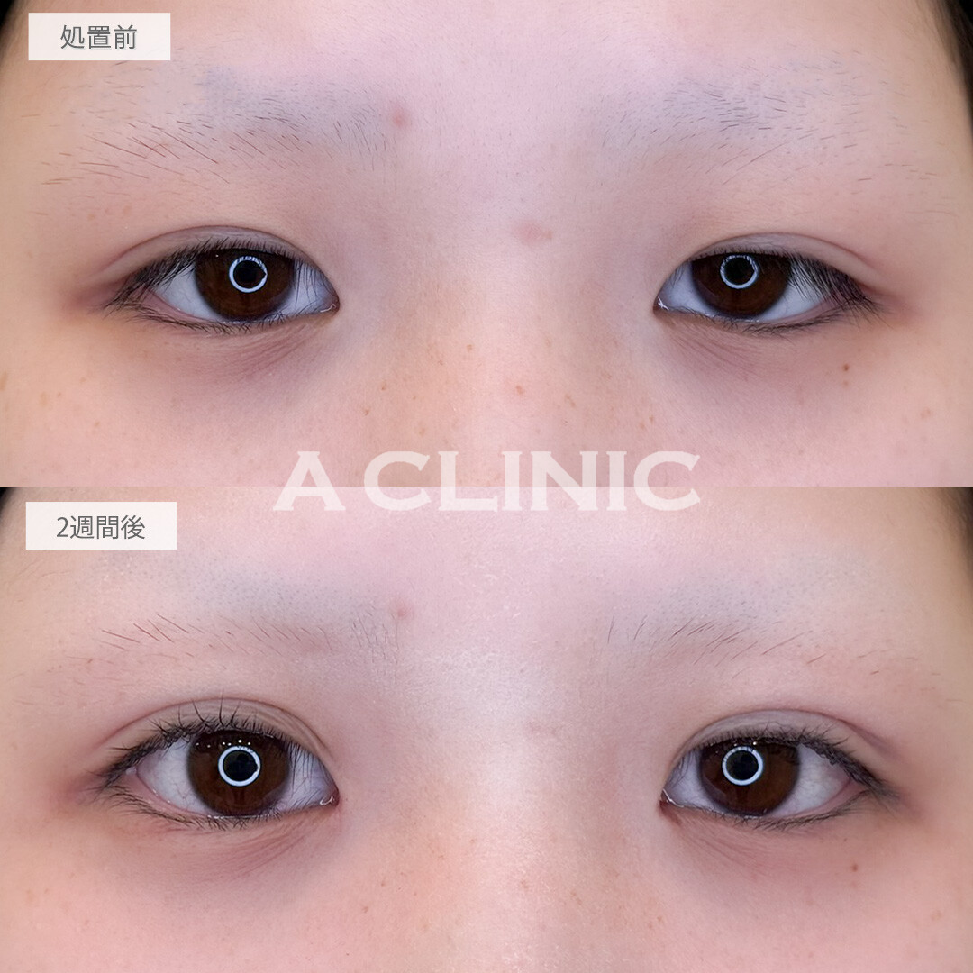 二重術埋没法で瞼の重たさが解消され目の見開きがよくなりました！処置前と2週間後の症例です(10代女性)