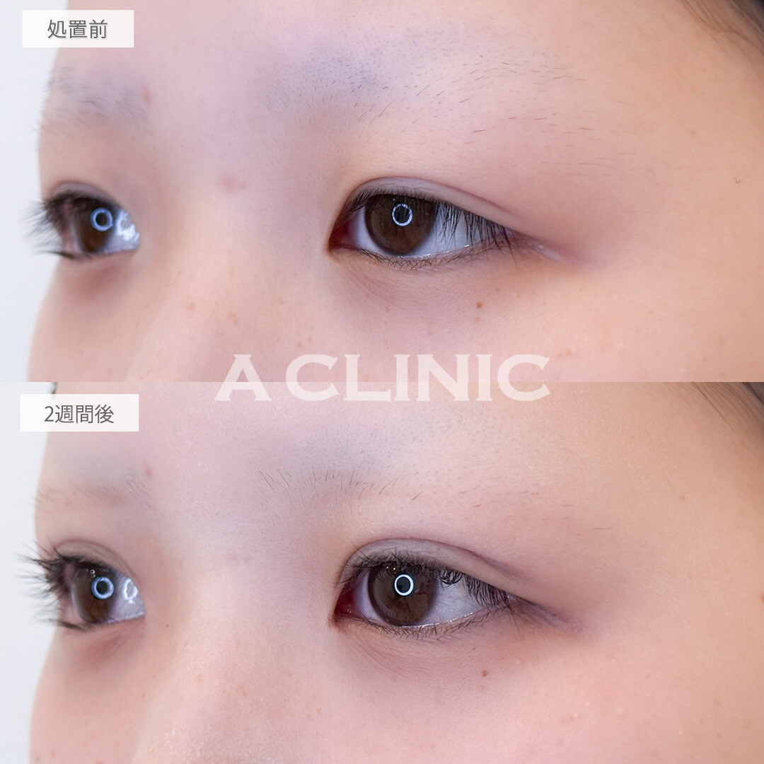 二重術埋没法で瞼の重たさが解消され目の見開きがよくなりました！処置前と2週間後の症例です(10代女性)