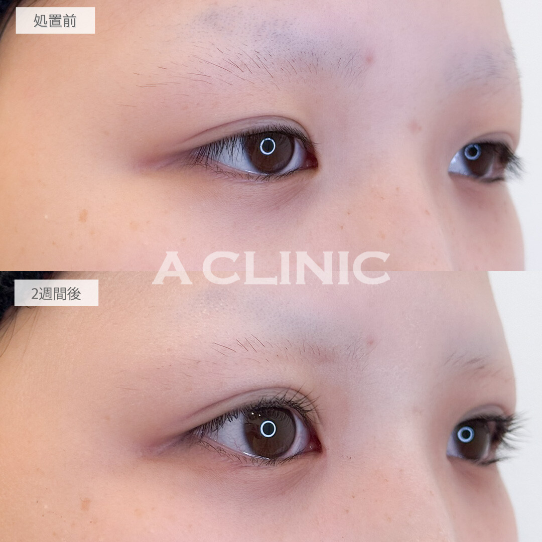 二重術埋没法で瞼の重たさが解消され目の見開きがよくなりました！処置前と2週間後の症例です(10代女性)