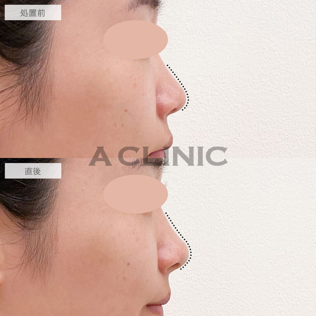 鼻ヒアルロン酸で鼻先をツンと尖らせ垢抜けに成功！こちら処置前と直後の症例です(20代女性)