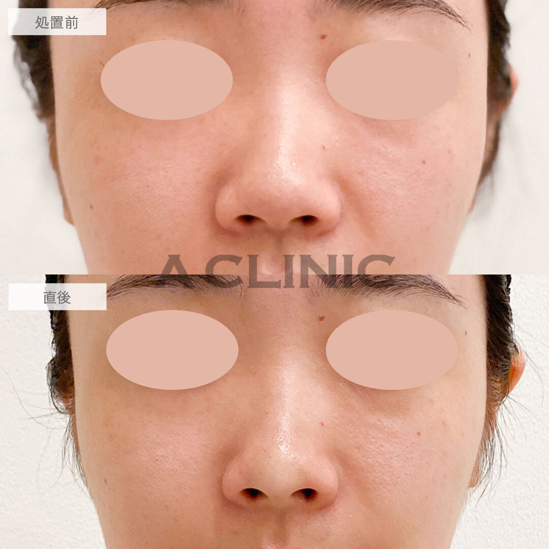 鼻ヒアルロン酸で鼻先をツンと尖らせ垢抜けに成功！こちら処置前と直後の症例です(20代女性)