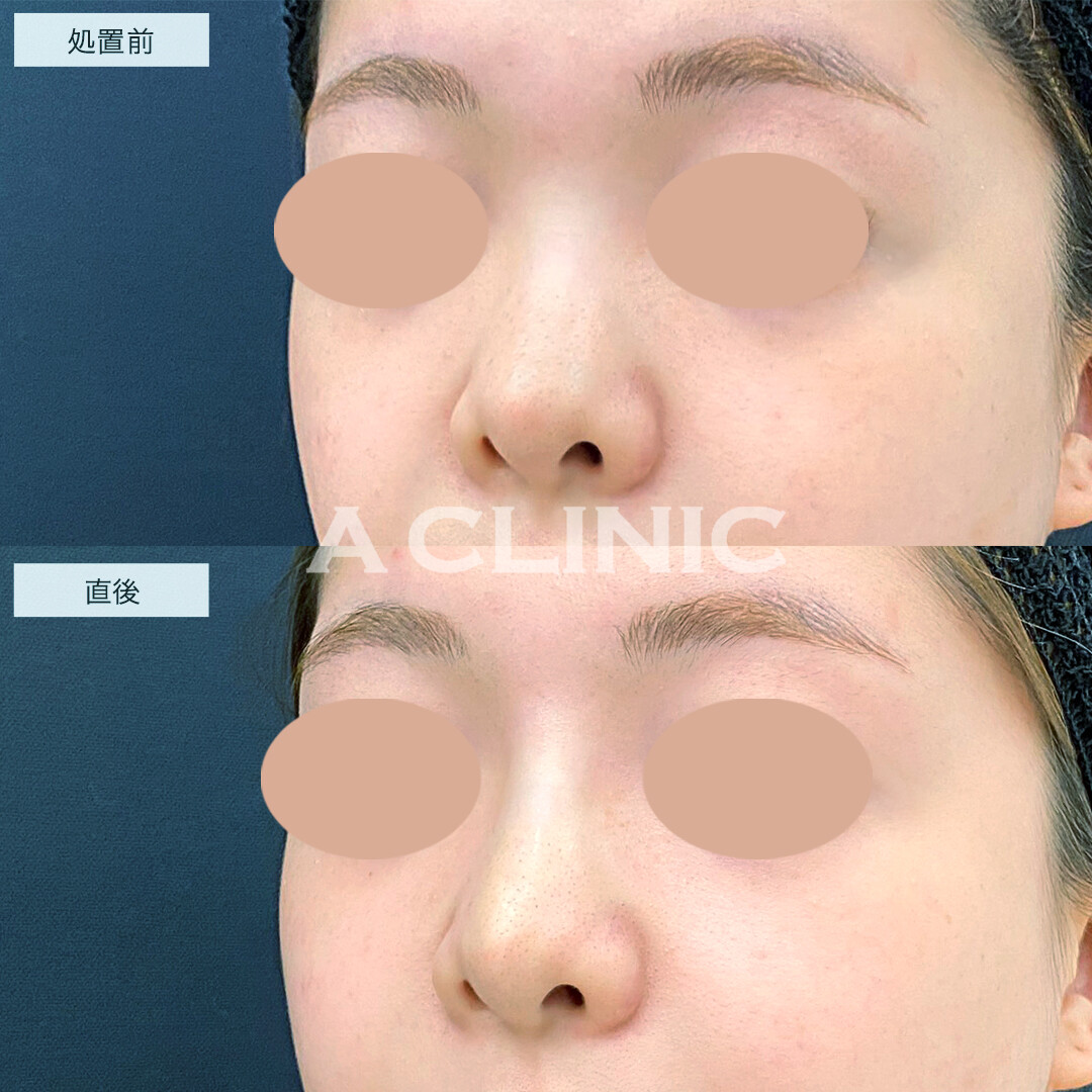 鼻のヒアルロン酸注入でスラッとした顔立ちに！処置前と直後の症例です(20代女性)
