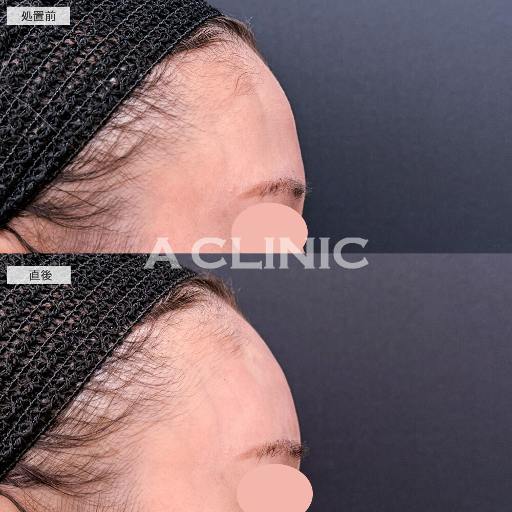 額出し、コメカミヒアルロン酸注入で、どの角度から見ても綺麗な額になりました！こちら処置前と直後の症例です(30代女性)