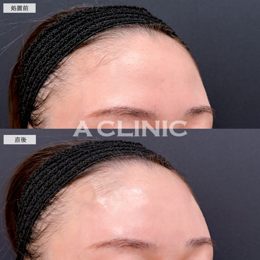 額出し、コメカミヒアルロン酸注入で、どの角度から見ても綺麗な額になりました！こちら処置前と直後の症例です(30代女性)