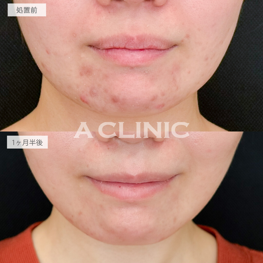 イソトレチノインで顎にできる大きな赤ニキビもあっという間に激減！処置前と1ヶ月半後の症例です(20代女性)