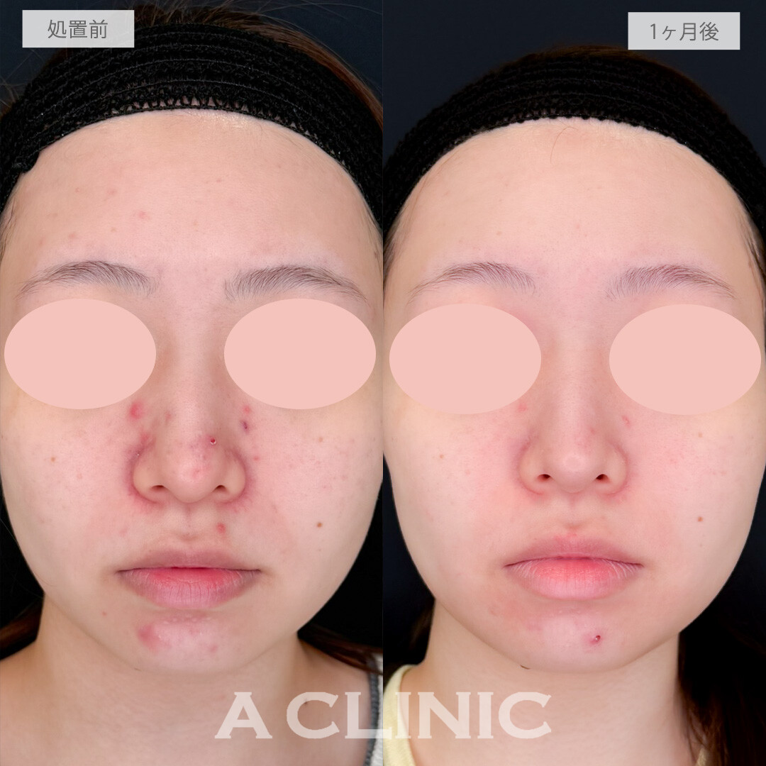 イソトレチノインで1ヶ月でここまでニキビ減少できました！処置前と1ヶ月後の症例です(20代女性)