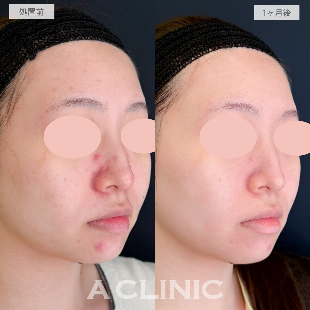 イソトレチノインで1ヶ月でここまでニキビ減少できました！処置前と1ヶ月後の症例です(20代女性)