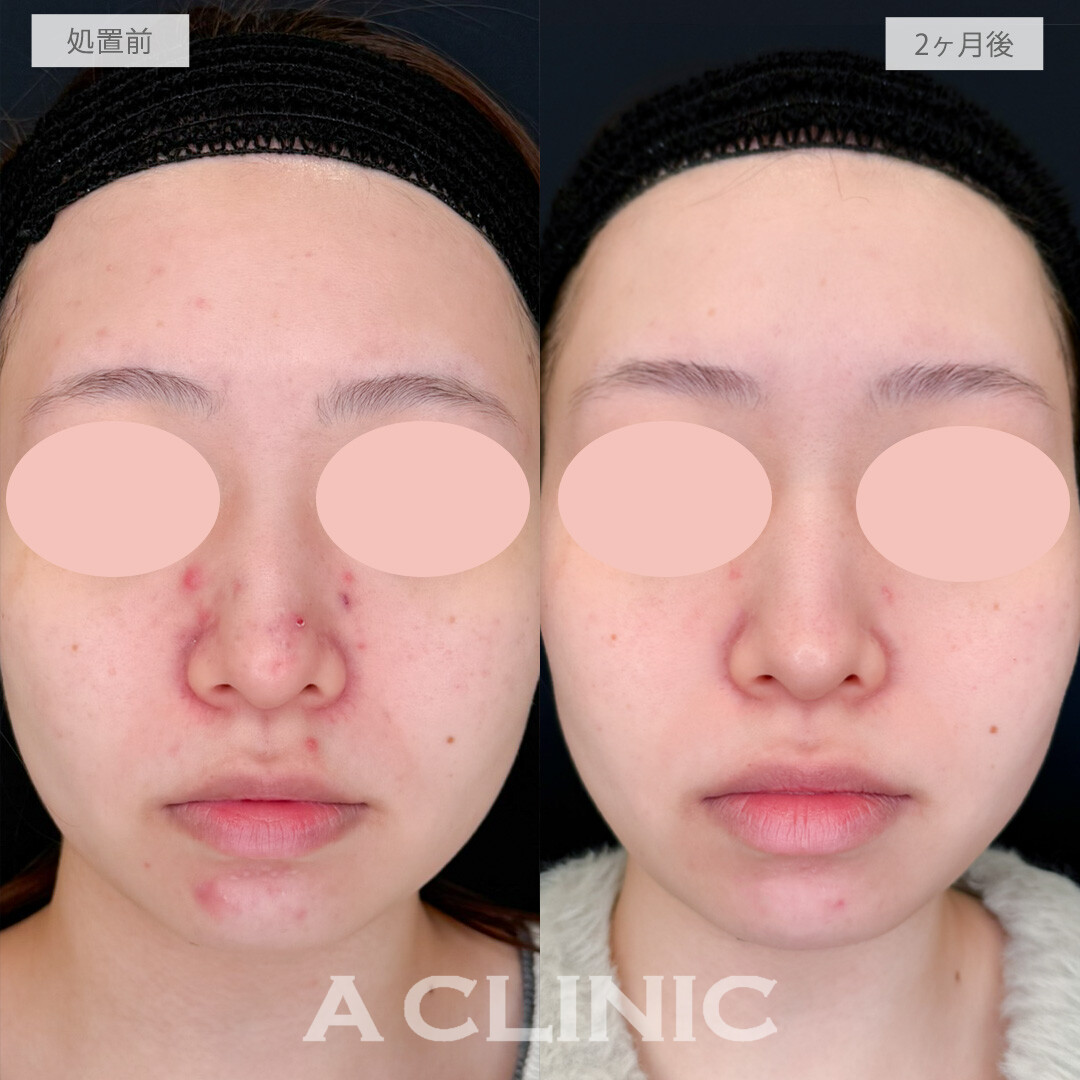 イソトレチノインで繰り返す頑固な赤ニキビを撃退！処置前と2ヶ月後の症例です(20代女性)