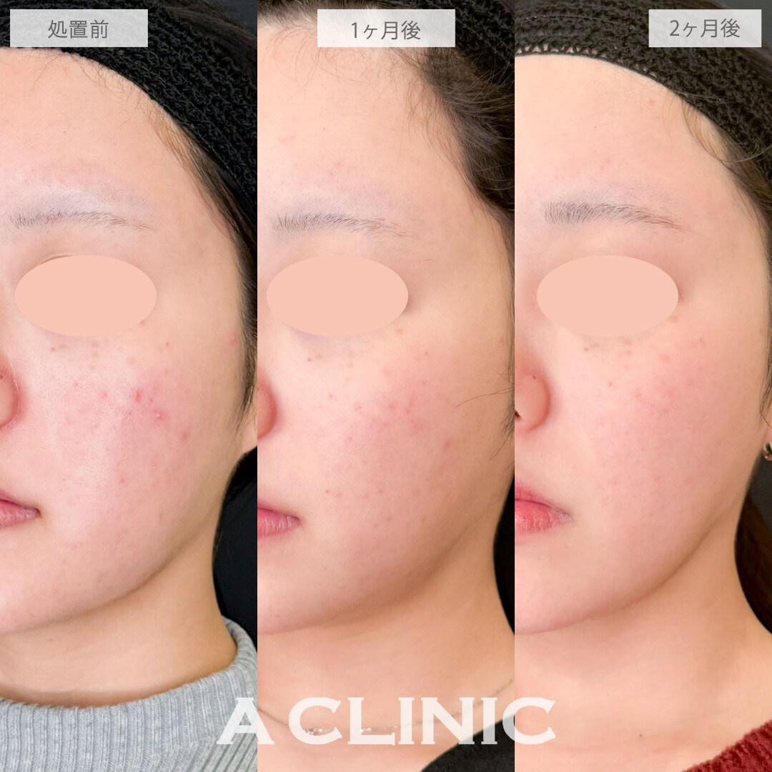 イソトレチノインで皮脂量を減らしてニキビと毛穴を改善させました！こちら処置前から2ヶ月後の症例です(20代女性)
