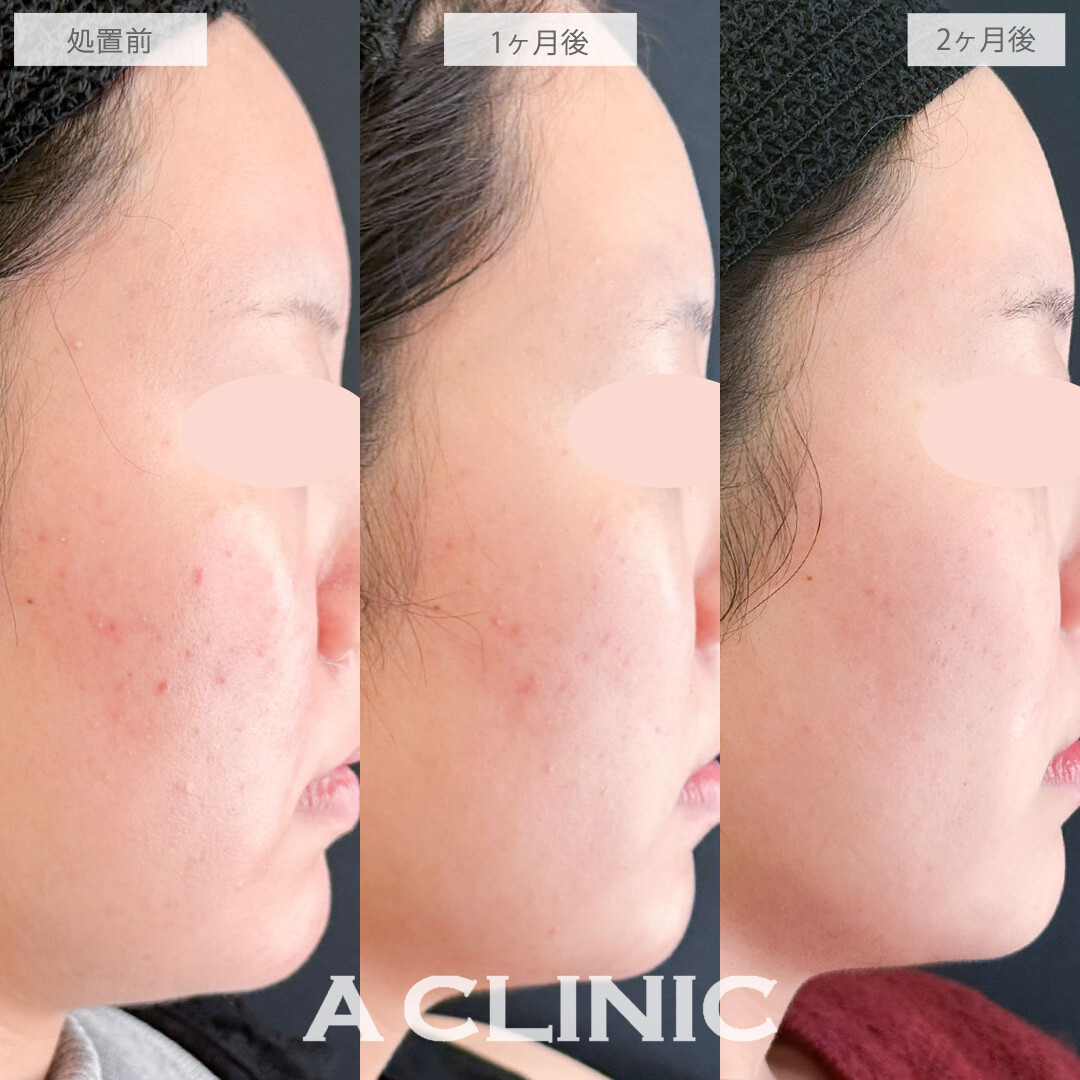 イソトレチノインで皮脂量を減らしてニキビと毛穴を改善させました！こちら処置前から2ヶ月後の症例です(20代女性)