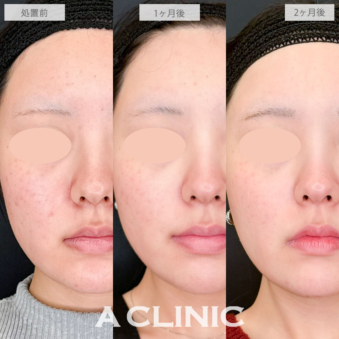 イソトレチノインで皮脂量を減らしてニキビと毛穴を改善させました！こちら処置前から2ヶ月後の症例です(20代女性)