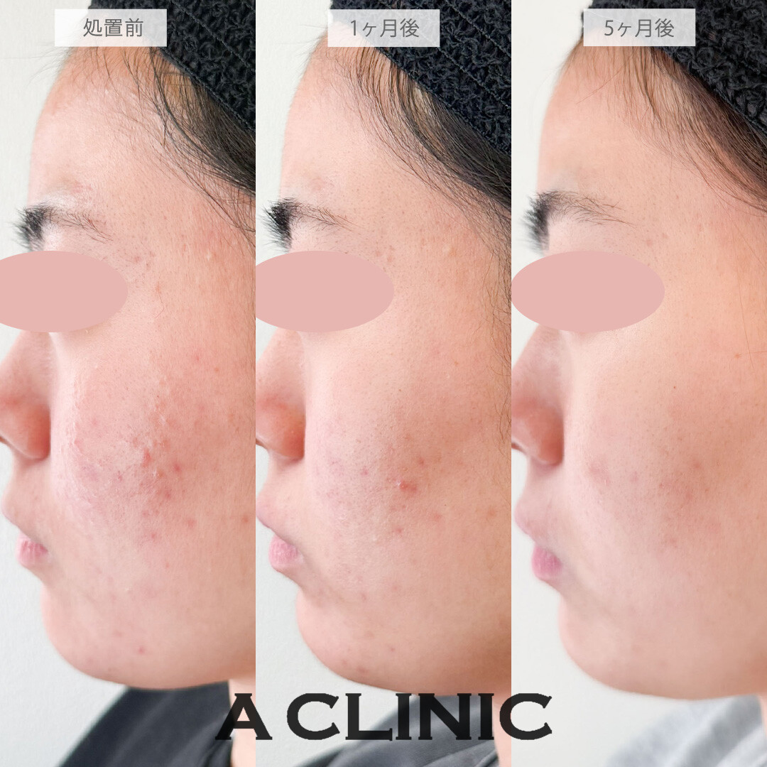 イソトレチノインで悩んでいたニキビが改善されました！こちら処置前から5ヶ月後の症例です(20代女性)