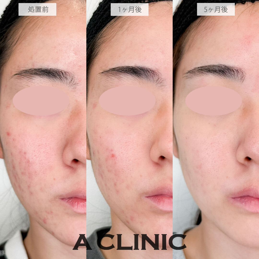 イソトレチノインで悩んでいたニキビが改善されました！こちら処置前から5ヶ月後の症例です(20代女性)