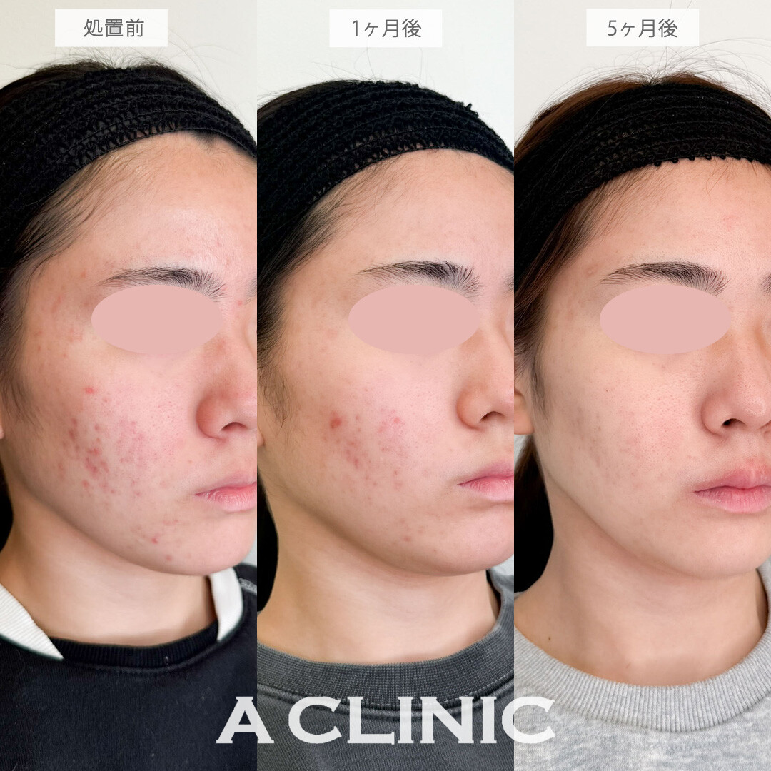 イソトレチノインで悩んでいたニキビが改善されました！こちら処置前から5ヶ月後の症例です(20代女性)