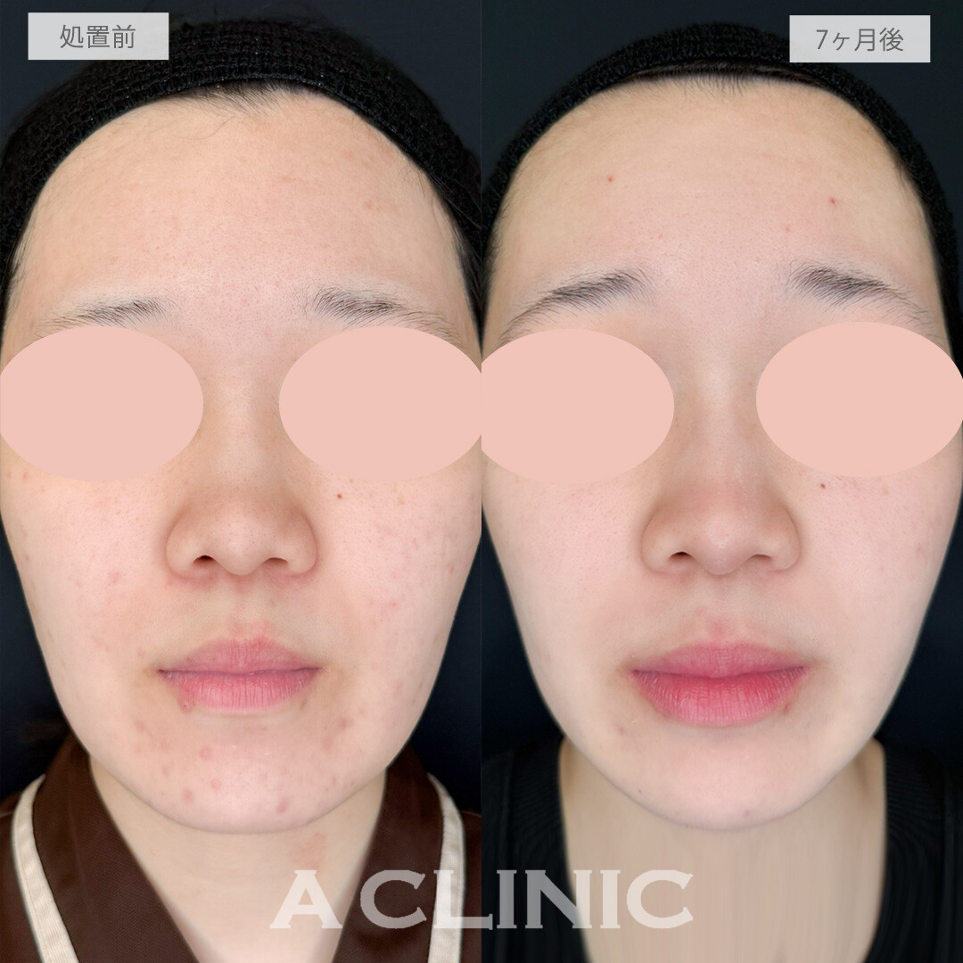 イソトレチノインで顎やフェイスラインのニキビを改善し顔色が明るく見えるようになりました！処置前と7か月後の症例です(20代女性)
