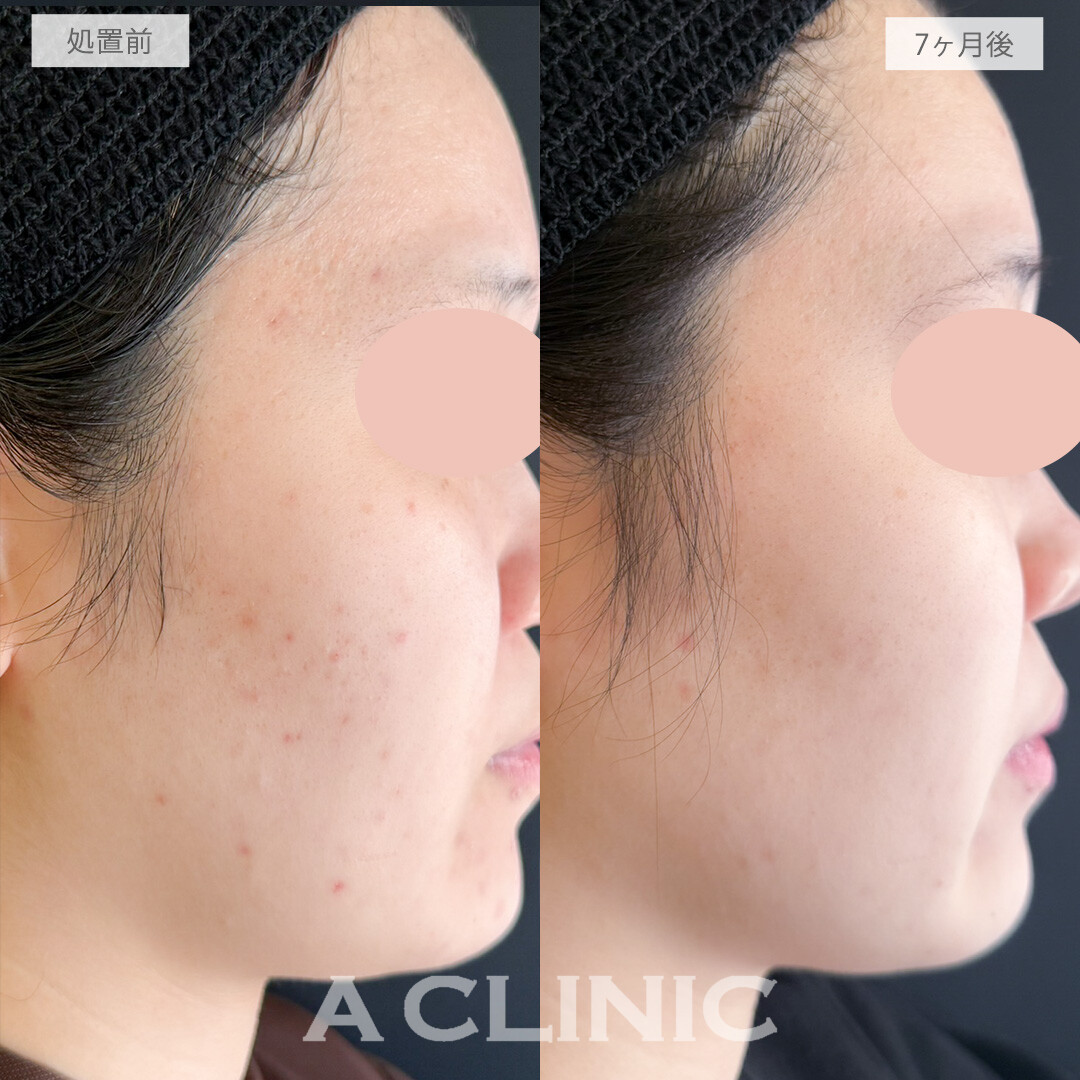 イソトレチノインで顎やフェイスラインのニキビを改善し顔色が明るく見えるようになりました！処置前と7か月後の症例です(20代女性)