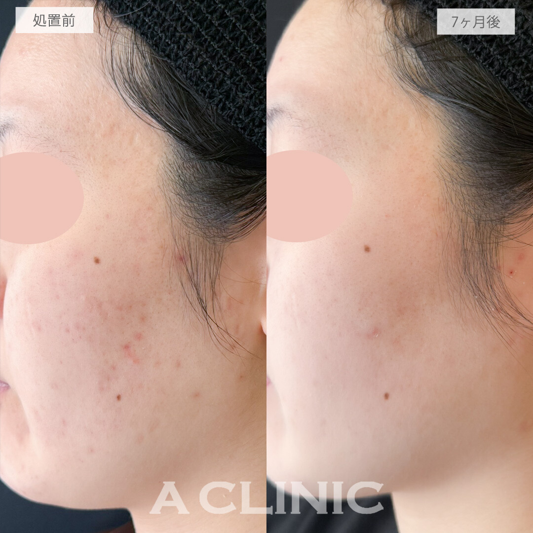 イソトレチノインで顎やフェイスラインのニキビを改善し顔色が明るく見えるようになりました！処置前と7か月後の症例です(20代女性)