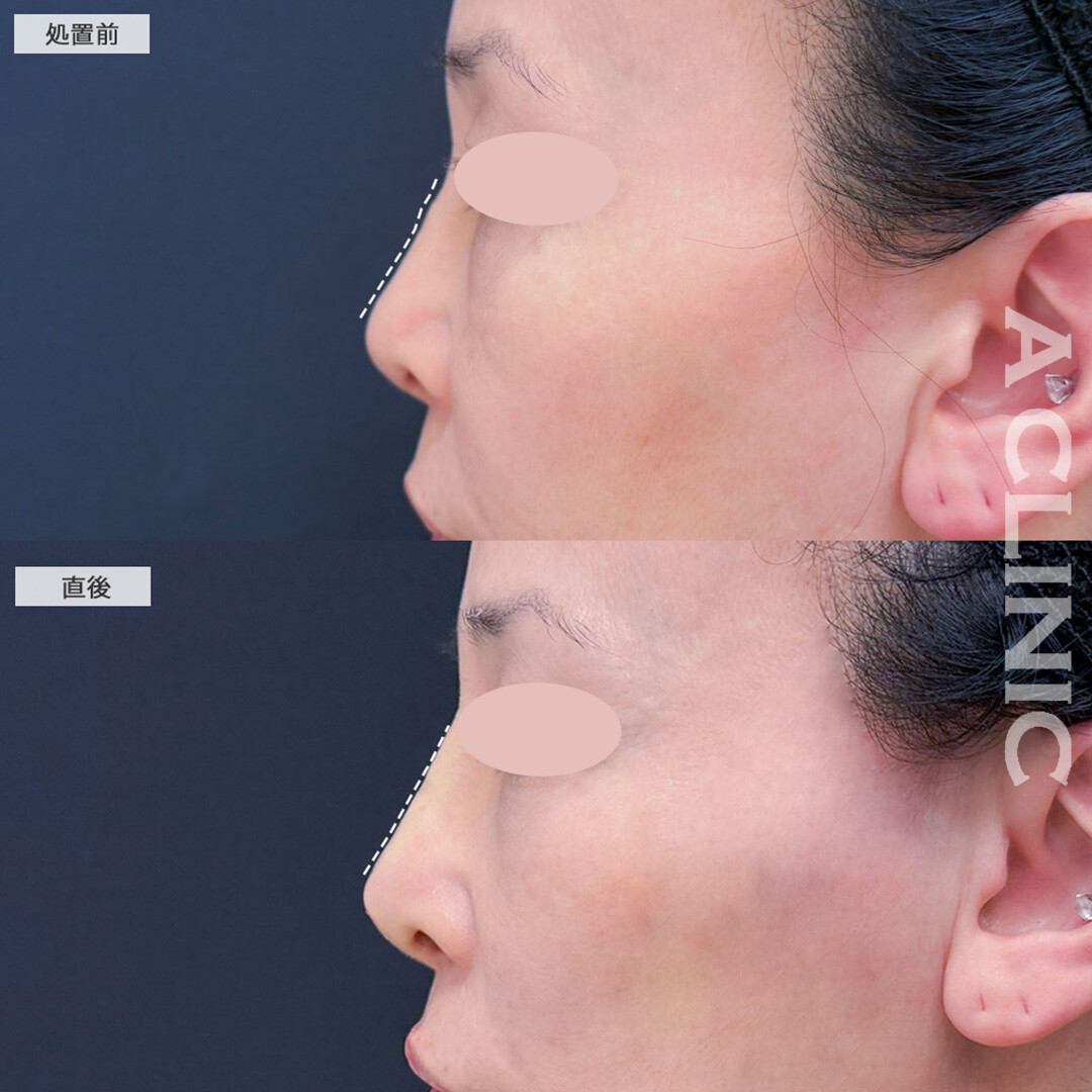 ジャスミンノーズ処置で鼻の凸凹を解消し自然と鼻が高くなりました！こちら処置前と直後の症例です(60代女性)
