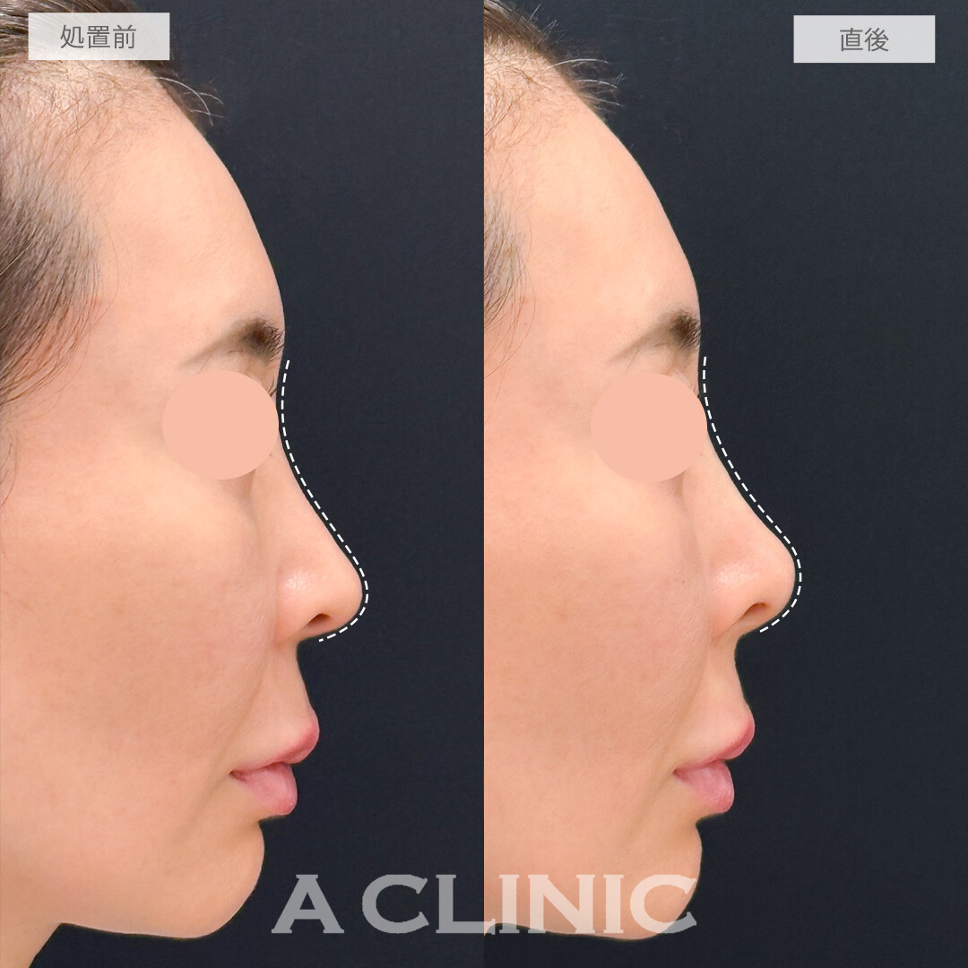 ジャスミンノーズで全体的に高さをだしつつ鼻中隔を形成して理想の鼻になれました！処置前と直後の症例です(50代女性)