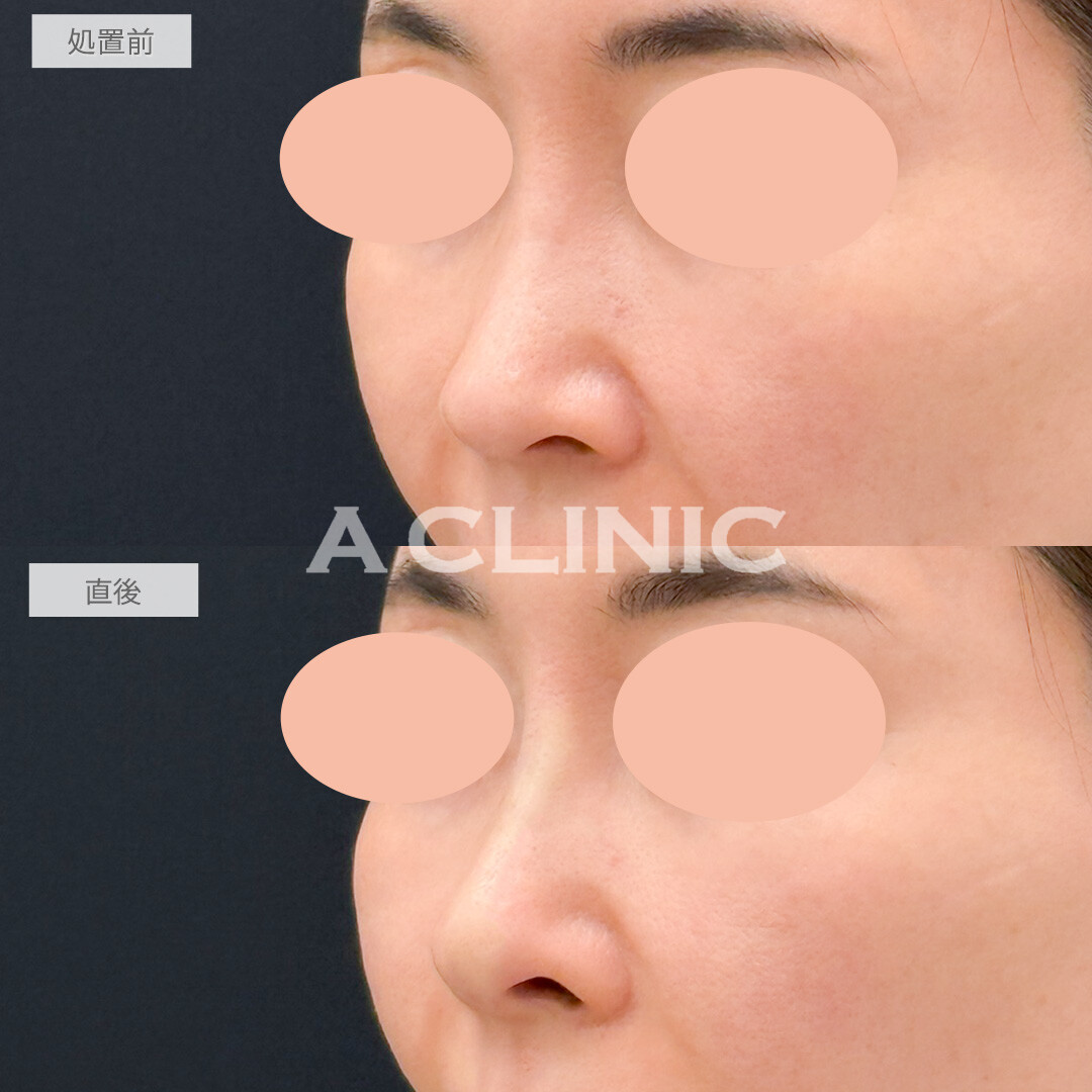 ジャスミンノーズで全体的に高さをだしつつ鼻中隔を形成して理想の鼻になれました！処置前と直後の症例です(50代女性)