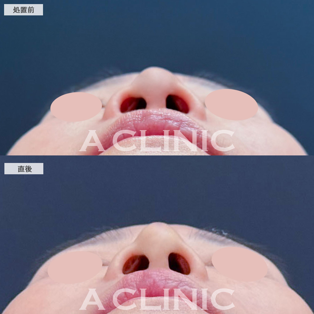 ジャスミンノーズ処置で鼻の凸凹を解消し自然と鼻が高くなりました！こちら処置前と直後の症例です(60代女性)