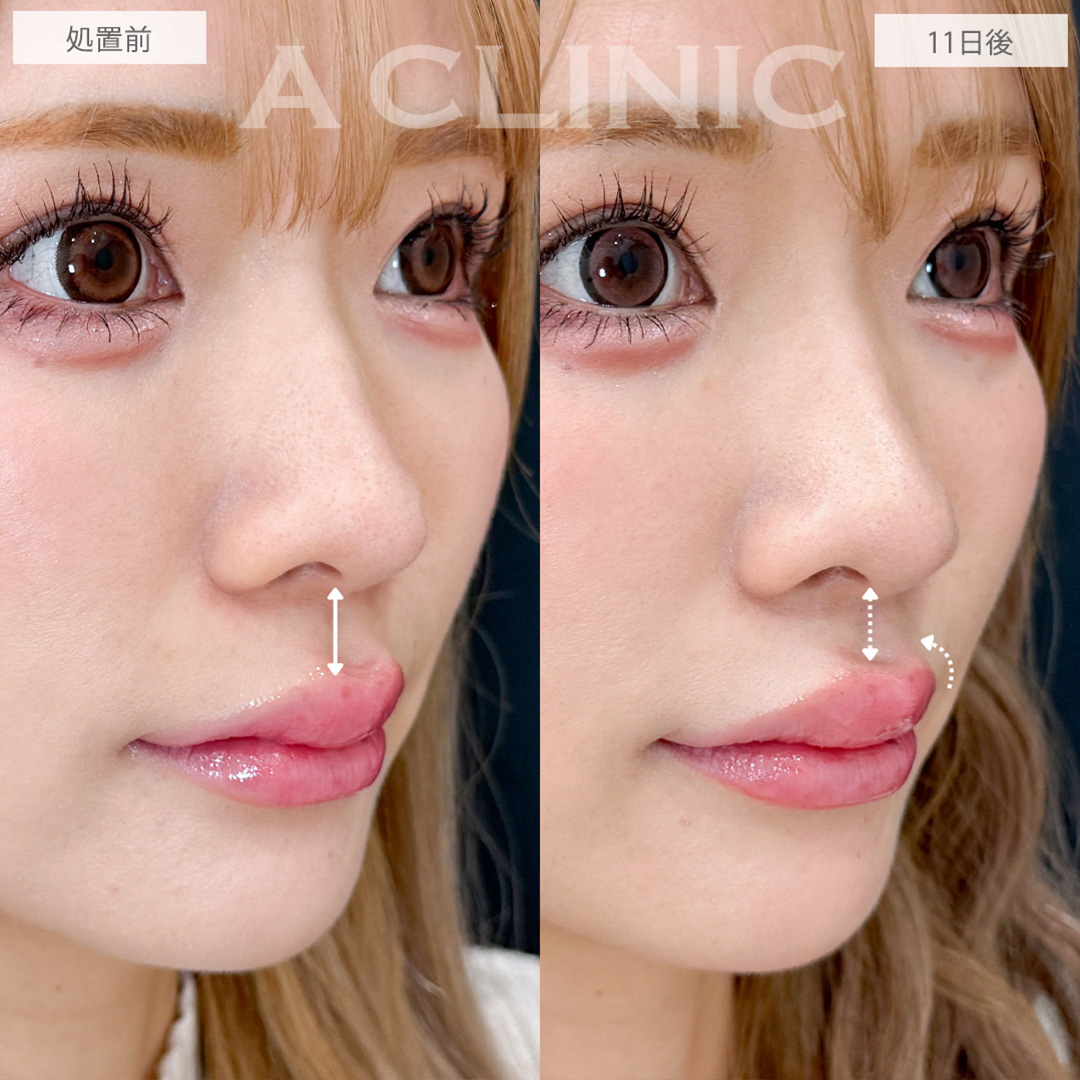 切らない人中短縮なら傷跡ナシで人中を短く見せられます！こちら処置前と11日後の症例です(30代女性)